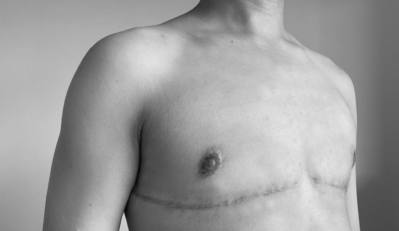 Foto in Schwarzweiss: Oberkörper einer Person mit horizontalen Narben unterhalb der Brust nach einer Mastektomie